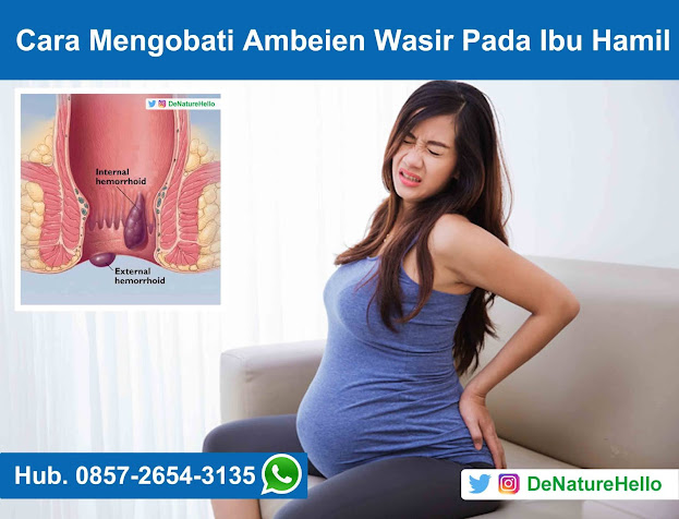 Cara Mengobati Wasir Ambeien Pada Ibu Hamil