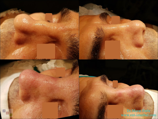 Male Rhinoplasty,Revision Rhinoplasty Operation With Rib Cartilage,Tertiary Revision Nose Aesthetic Surgery,Tertiary Revision Nose Job in Istanbul,