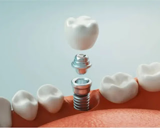 زراعة الأسنان بالتفصيل أنواعها و الطريقة و التكلفة