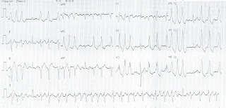   ekg คือ, ekg ผิดปกติ, ekg 12 lead ปกติ, normal sinus rhythm คือ, basic ekg, p wave คือ, การติด ekg monitor, กราฟคลื่นหัวใจผิดปกติ, ekg ย่อมาจาก