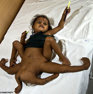 8 Incredible Mutant Babies Pictures Seen on www.VyperLook.com