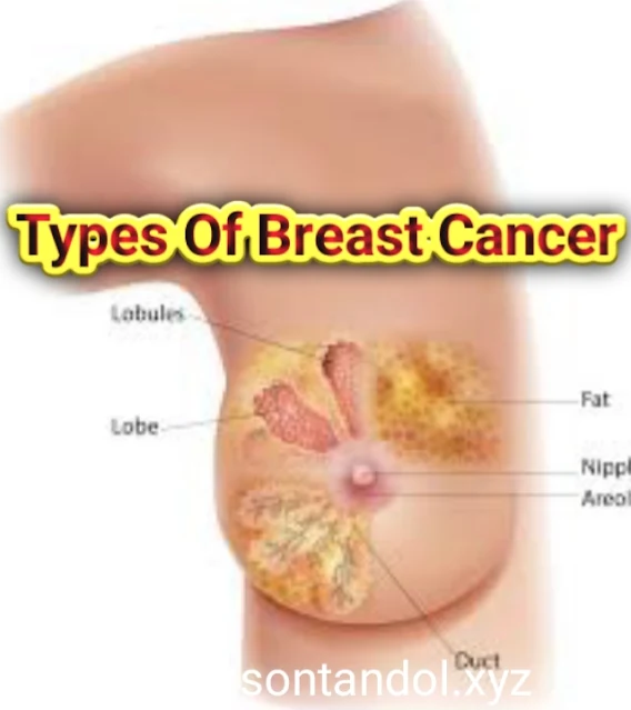 What Types Of Breast Cancer Have The Highest Recurrence Rates? - Solution Mind