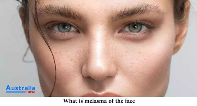 What is melasma of the face?