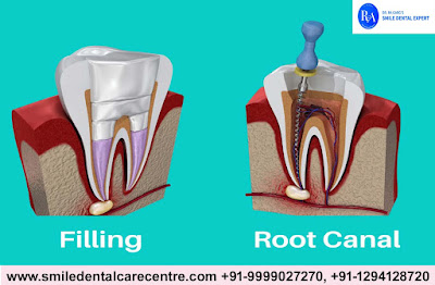 Painless Root Canal Treatment In India