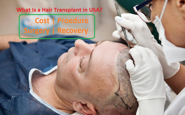 Hair Transplant USA Cost, Procedure, Recovery & More