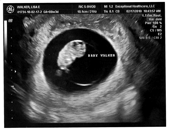 Baby Ultrasound 9 Weeks