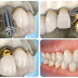 Hiệu quả của trồng răng implant mang lại