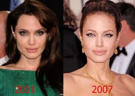 Angelina Jolie Plastic Surgery Before And After