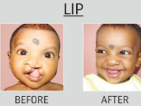  Meenakshi Mission Hospital completes  11,000 free cleft lip and palate surgeries  