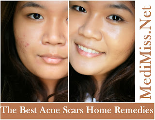 The Best Acne Scars Home Remedies