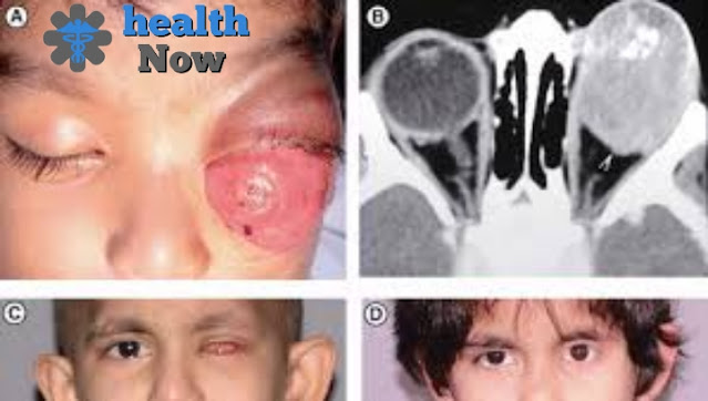 Diagnosis of retinoblastoma.