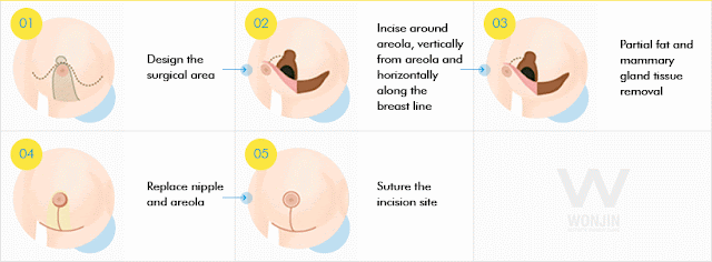 짱이뻐! - Korean Breast Plastic Surgery - Breast Lift