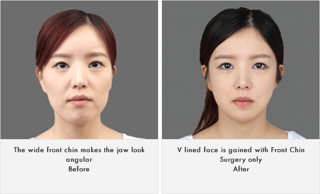 짱이뻐! - Korean Face Contouring - Front Chin Surgery