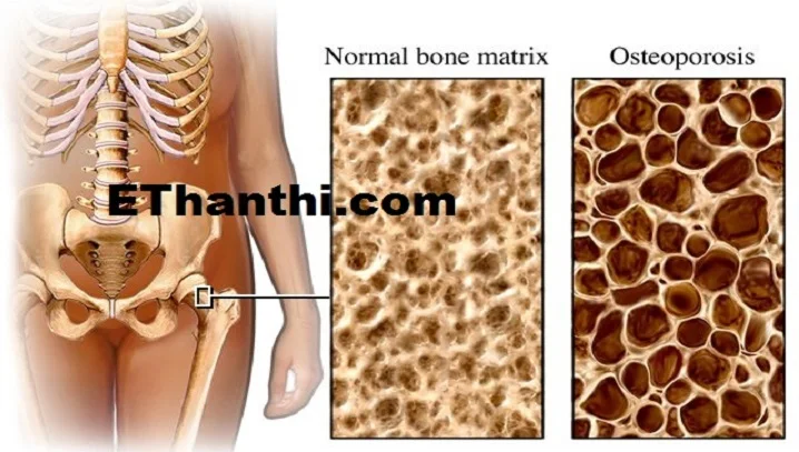 ஆஸ்டியோ போரோசிஸ் வர காரணமும் சிகிச்சையும் !