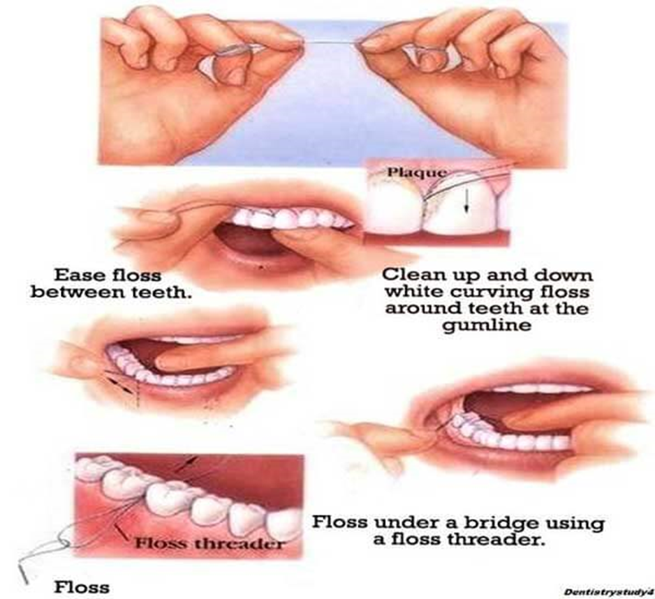 Dental hygiene / Oral hygiene| dental plaque| Dental floss