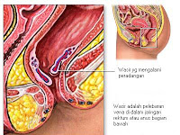 Obat Ambejoss untuk Ibu Menyusui