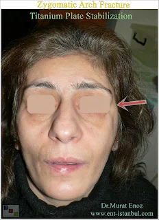 zygomatic arch anatomy, zygomatic arch fracture, titanium plate stabilization, zygomaticomaxillary complex fracture, open reduction and internal fixation, facial trauma, zygomatic fracture treatment, masseter muscle, rigid fixation, biocompatibility, comminuted fracture,