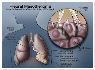 Mesothelioma is a Type of Cancer