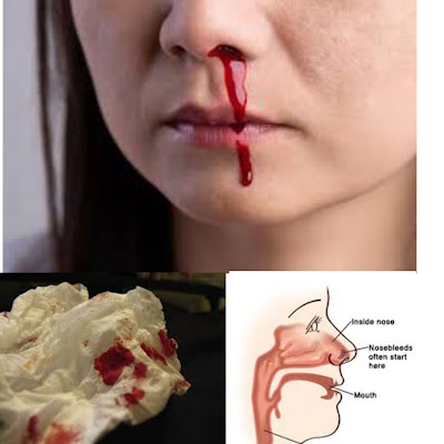 Why Is My Nose Bleeding?  A few things can set off a nosebleed.