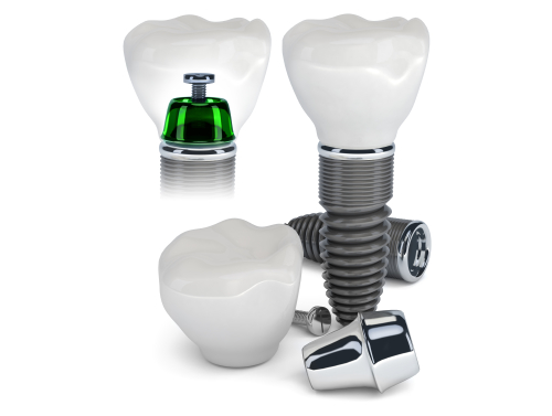  Dental Implants