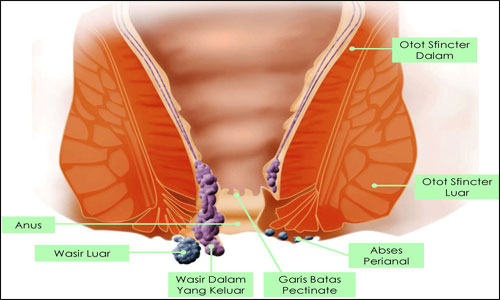 cara mengempiskan ambeien,  posisi tidur yang baik untuk penderita ambeien,  penyebab sakit ambeien,  penyebab ambeien dan cara mengobatinya, 