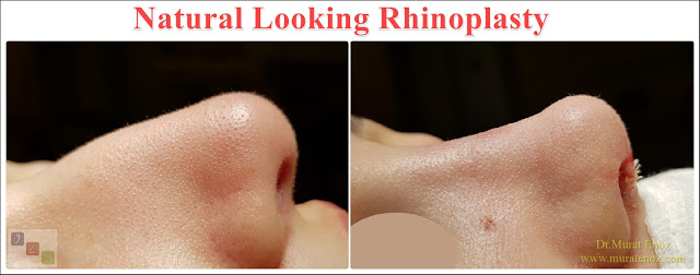 Natural Looking Rhinoplasty - Natural Nose Job - Natural Rhinoplasty - Female Nose Aesthetic Surgery - Nose Jobs For Women - Nose Reshaping for Women - Best Rhinoplasty For Women Istanbul - Female Rhinoplasty Istanbul - Nose Job Surgery for Women - Women's Rhinoplasty - Nose Aesthetic Surgery For Women - Female Rhinoplasty Surgery in Istanbul - Female Rhinoplasty Surgery in Turkey