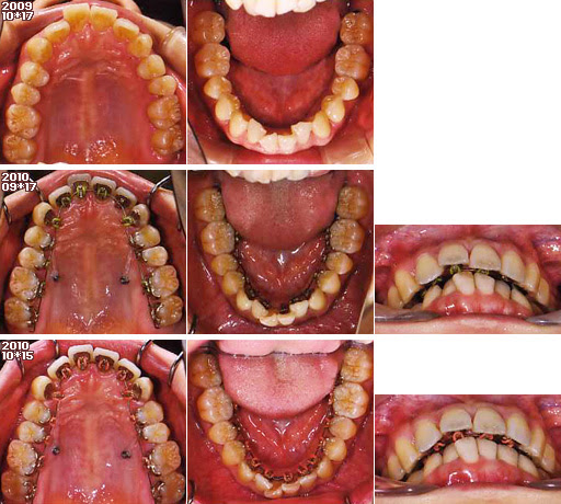 歯列矯正：定期検診2