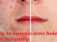How to remove acne holes on face naturally