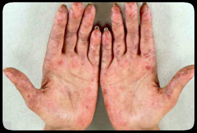 what are the symptoms of lupus plus