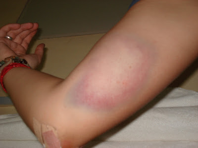broken arm bruise. My arm about a few hours after