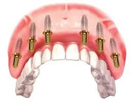 Mất răng nguyên hàm trồng bao nhiêu trụ implant ?