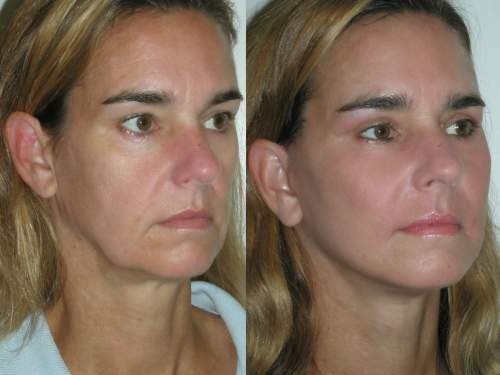 A Natural Trick That Reduces Deep Wrinkles