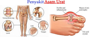 asam urat obat alami, obat untuk asam urat, obat herbal asam urat, obat asam urat tradisional, obat kolesterol