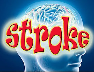 Gejala Stroke dan Pengobatannya