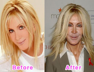 Celebrity Plastic Surgery on Fresh Pic  16 Worst Celebrity Plastic Surgery Disasters