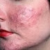 Mengenal Gangguan Kulit Rosacea