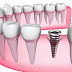 Trồng răng hàm bao nhiêu tiền khi cắm implant?