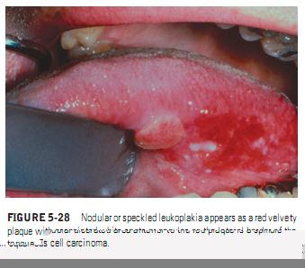 IDIOPATHIC “TRUE” LEUKOPLAKIA