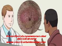 obat kutil kelamin,tanda kutil kelamin,gejala kutil kelamin,ciri ciri kutil kelamin,muncul kutil di sekitar kelamin,obat kutil tanpa operasi,cara menghilagkan kutil kelamin tanpa operasi