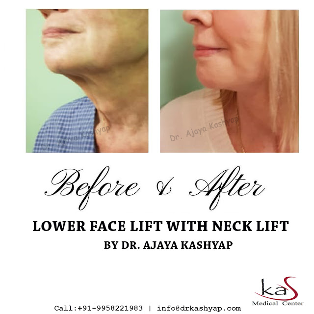 face lift surgery in india