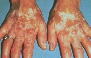 vitiligo patches in hands