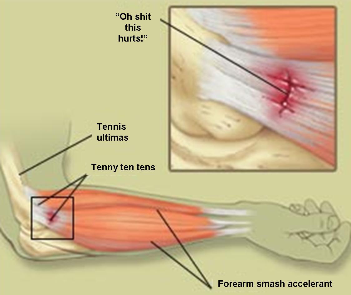 Fast Relief For Tennis Elbow : Avoid Exercise Injuries