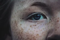 How can we get rid of your freckles