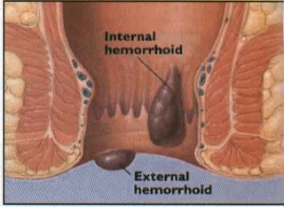 Mengobati Wasir Internal