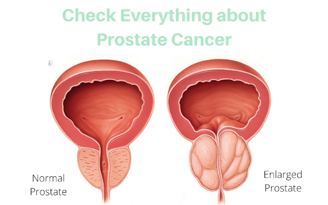 prostate cancer