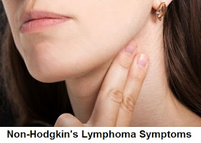 Non-Hodgkin's Lymphoma: Symptoms, Diagnosis And Treatment