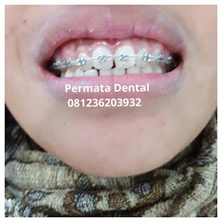 gambar foto behel bracket kawat gigi sebelum dan sesudah perawatan untuk memperbaiki merapikan gigi gingsul gigi miring renggang tonggos berantakan keluar masuk jarang diastema maju mundur tidak rapi tidak beraturan bali denpasar banyuwangi jember tidak rata kocar kacir