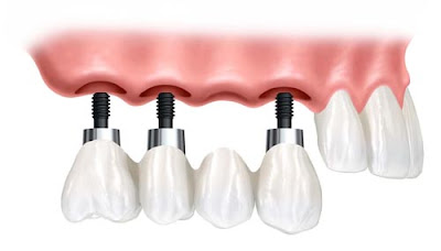 Số răng implant cần cấy ghép không nhất thiết phải bằng số răng bị mất