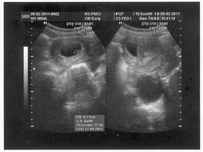 Penggunaan USG ultrasonography pada kehamilan  Attayaya Blog