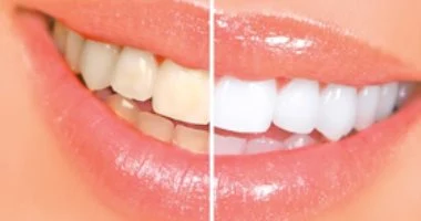 Bleaching teeth with photoshop   شرح اسهل طريقة لتبيض الاسنان بأستخدام برنامج فوتوشوب photoshop tutorials,• tutorial photoshop,• photoshop tutorial,• how to photoshop,• photoshop cc,• adobe photoshop,• photoshop, • photo,• photo editor,• picture editing,• photo manipulation,• photo manipulation artists,• photo editing software,• photo restoration, • edit photos,• editing photos,• photography,• photo effects,• photo editors,• photo editing,• free photo editing,• photo editing online,• pictures editing,• photo edit,• photoshop lessons,• photoshop training, • online photoshop classes,• photoshop course,• photoshop training courses,• online photoshop class,• amazing photoshop tutorials, • photoshop training course,• adobe photoshop courses,• graphic design tutorials photoshop,